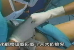 人流手术视频,真实视频解析